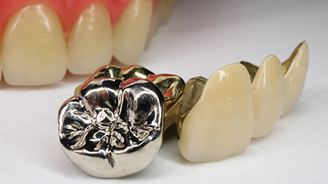 銀歯のデメリットとメタルフリー治療への取り組み