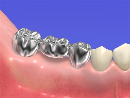 保険ブリッジ（メタル・レジン）