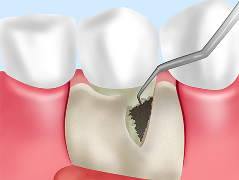歯周ポケットそうは術